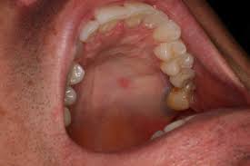Lumps and bumps aren't uncommon in your mouth. Small Hard Lump On Roof Of Mouth Help Oral And Dental Problems Forums Patient