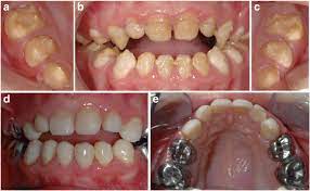 Amelogenesis Imperfecta Therapeutic Strategy From Primary To Permanent Dentition Across Case Reports Bmc Oral Health Full Text