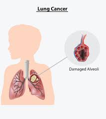 Lung cancer usually has no symptoms in its early stages. 8 Signs And Symptoms Of Lung Cancer In Children