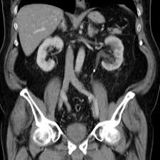 Image result for Nephrolithiasis Imaging