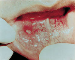 Image result for Aphthasol