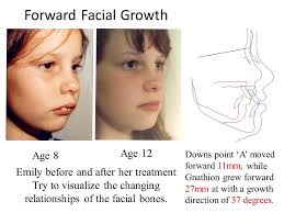 One of the secrets of Freddie Mercury's vocal recording and talent is  precisely the shape of his teeth. The latter have contributed to his  interpretation style even deeper. Not in vain, Queen's