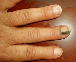 Impreuna cu bubitele albicioase la partea din spate a gatului, veti avea. Ce Spun Petele Negre Galbene Sau Albe De Pe Unghiile Tale