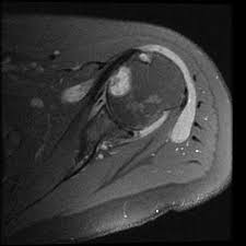 Image result for Shoulder MRI