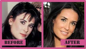 Demi moore, 58, is rumored to have had plastic surgery done on her face before she appeared on her debut runway walk on the fendi runway . Demi Moore Demi Moore Plastic Surgery Celebrity Plastic Surgery