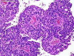 Webpathology Com A Collection Of Surgical Pathology Images