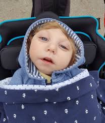 Happy Birthday Jax! Baby born with half a head is thriving against all the  odds