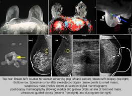Image result for Mammogram Interpretation
