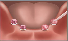 We did not find results for: Chairside Attachment Processing Material Zest Dental Solutions