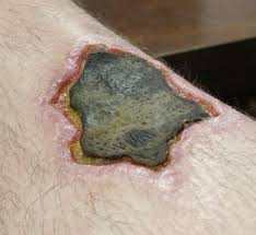 Image result for wolf spider bite skin