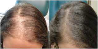 First, a doctor or assistant draws between 15 and 60 cubic centimeters (cc) of blood from the person's arm. Prp For Hair Loss Dr Medispa Award Winning Clinics
