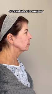 NayakPlasticSurgery (@nayakplasticsurgery)’s videos with original sound