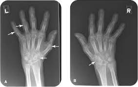 Rheumatoid arthritis (ra) is the most common type of autoimmune arthritis. Rheumatoid Arthritis Radiology Key