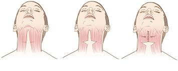 Neck Lift
