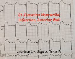 Image result for ST Elevation