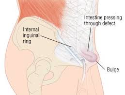 Energy diagram for endothermic reaction. Inguinal Hernia Guide Causes Symptoms And Treatment Options