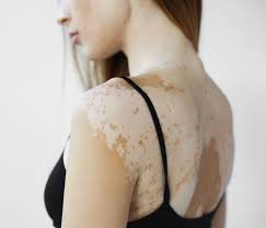 Image result for Vitiligo