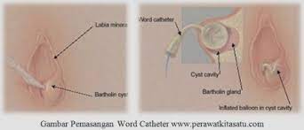 Check spelling or type a new query. Asuhan Keperawatan Pada Pasien Kista Bartholini