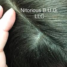 There is a misconception that african american hair, because it is coarse, is resistant to head lice. Does Your Client Have Lice This Is What To Do Behindthechair Com
