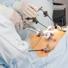 The left upper quadrant or palmer's point was developed by raoul palmer who advocated the insertion of the veress needle at a range of 3 cm below the left subcostal in the midclavicular line (fig. Complications Of Laparoscopic And Robotic Surgery