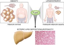 Image result for Lipodystrophy