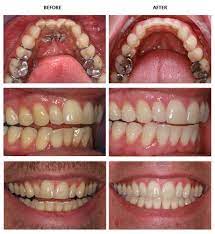 Teeth Straightening With Inman Aligners Dental Braces Dental Retainer Dentist