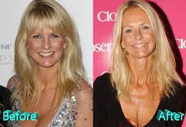 We did not find results for: Ulrika Jonsson Plastic Surgery Did It Improve Or Degrade Her Looks Cosmetic Surgery Celebrity Plastic Surgery Plastic Surgery