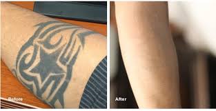 Understanding Tattoo Removal Process Tech Senser Technology And General Guide