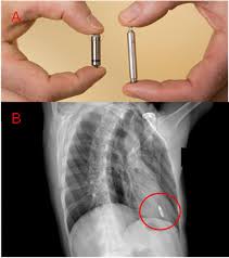 No intervention required *if the cied is close to the surgical field or there are clinical concerns or questions, the. Second In A Series On Leadless Pacing Leadless Cardiac Pacemakers What Is To Be Expected From Future Developments