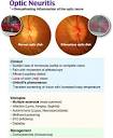 How is optic neuritis diagnosed? - Quora
