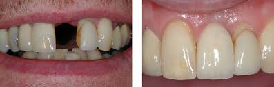 Privately a scale and polish will cost somewhere between £35 and £100. Stephen Emms Dentist Dental Implants Doncaster Nhs Dentist Doncaster