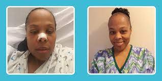 My Sinus Infection And Bronchitis Turned Out To Be A Brain Fluid Leak