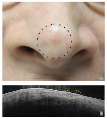 Basal cell and squamous cell skin cancers can look like a variety of marks on the skin. Optimal Cosmetic Outcomes For Basal Cell Carcinoma A Retrospective Study Of Nonablative Laser Management Mdedge Dermatology
