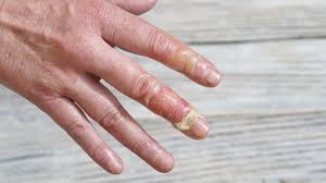 Seek medical attention for any burn that causes a blister. Burn Relief How To Treat A Steam Burn Coastal Urgent Care Houma