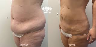 Image result for Liposuction
