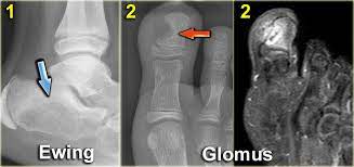 What do scientists think about outbreaks of bird flu? The Radiology Assistant Differential Diagnosis Of Bone Tumors