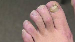 See which ones are important to you. Have Bad Toenail Fungus Try Laser Treatments