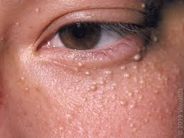 Image result for milium cyst on eyelid