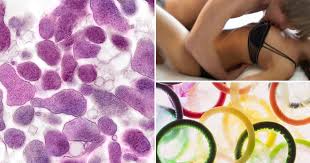 Image result for Mycoplasma genitalium