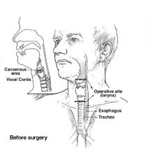 They may look like a patch or a lump or look like an ulcer. Throat Cancer Surgery What Is Surgery For Throat Cancer