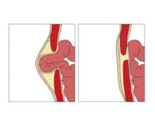 This happens because of the way that the umbilical blood vessels pass through the umbilical ring. Umbilical Hernia Wikipedia