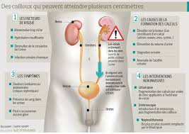 Ainsi quelques femmes peuvent réussir une peu d'urine, alors que d'autres. Calculs Urinaires Douloureux Mais Sans Lourdes Consequences