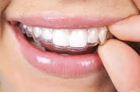 Diy Braces Save Student A Boatload Of Cash But Don T Try This At Home Teeth Straightening Invisalign Dental Braces