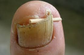 Foot Health Five Tips To Fix Dry And Brittle Toenails A Common Condition Podiatrists See Kyforward Com Kyforward Com The metatarsal bones leading to the fifth toe are one of the most common.