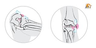 Injuries in this area are typically strained, sprained, stretched, or torn leg tissues that connect the leg to the groin, including: A Blessing For Your Knees Ashtangayoga Info