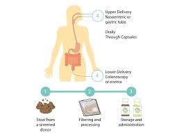 Image result for Fecal Transfer
