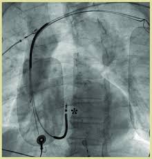 Undesfibriladorautomticoimplantable un desfibrilador automtico implantable (dai)esundispositivoquese (dai) es un dispositivo que se. Cable Ventricular Derecho De Un Desfibrilador Automatico Implantable Download Scientific Diagram