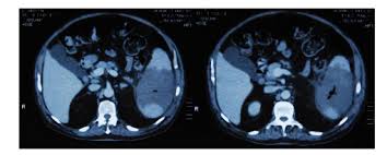 Mucormycosis (previously called zygomycosis) is a serious but rare fungal infection caused by a group of molds called mucormycetes. Mucormicosis Fatal No Sospechada En Uci