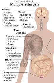 Check spelling or type a new query. Multiple Sclerosis Signs And Symptoms Wikiwand