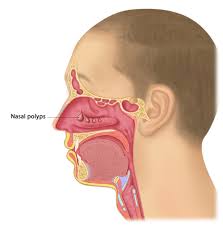 When too much mucus builds up in the sinuses, they can become. Chronic Rhinosinusitis Nasal Polyps Melbourne Ent Group